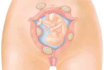 Міома матки і вагітність: вплив на зачаття дитини