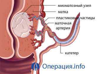 Міомектомія, операція з видалення міоми матки