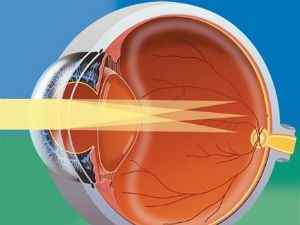 Міопічний астигматизм: види (простий, складний), причини, лікування короткозорого астигматизму обох очей