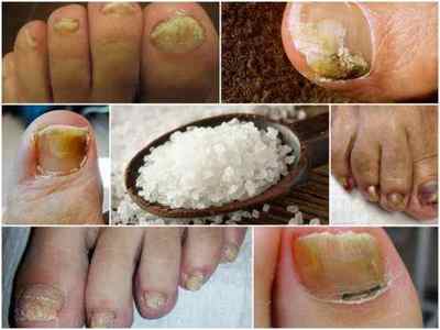 Морська сіль від грибка нігтів на ногах