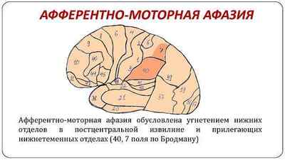 Моторна афазія після інсульту: сенсомоторна, амнестическая, сенсорна