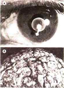 Мозкові черви у людини: симптоми і лікування глистів в голові