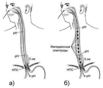 Імпедансометрія стравоходу і шлунка: що це таке, на чому заснована процедура, при яких станах показана, як проводиться, переваги