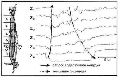 Імпедансометрія стравоходу і шлунка: що це таке, на чому заснована процедура, при яких станах показана, як проводиться, переваги