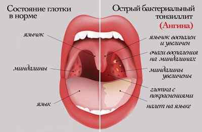 Мірамістин для горла: інструкція із застосування