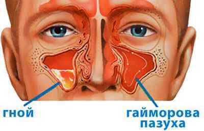Мірамістин при гаймориті і закладеності носа: інструкція із застосування