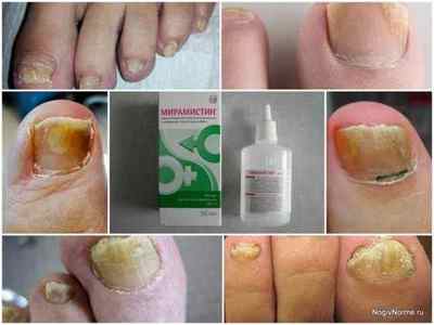 Мірамістин від грибка стопи і нігтів на ногах - інструкція та відгуки