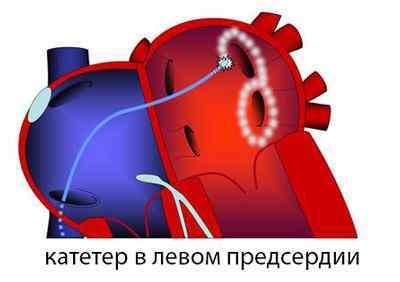 Мірча серця (радіочастотна абляція, припікання): операція при аритмії