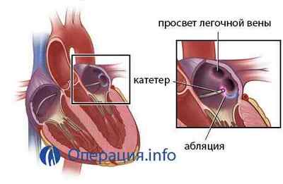 Мірча серця (радіочастотна абляція, припікання): операція при аритмії