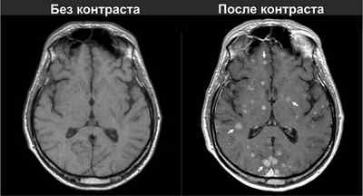 МРТ головного мозку з контрастом, що показує, в чому різниця