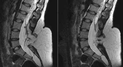 МРТ головного та спинного мозку: як виглядає пухлина спинного мозку на МРТ хребта, інтрадурально пухлини при склерозі | Ревматолог