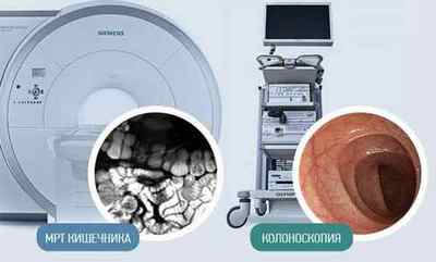 МРТ кишечника або колоноскопія: порівняння методик та їх інформативності