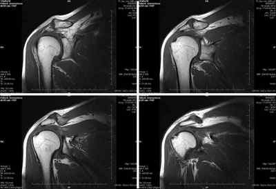 МРТ плечового суглоба: що показує і можна виявити на фото томографії, як роблять МРТ, анатомія плечового суглоба | Ревматолог