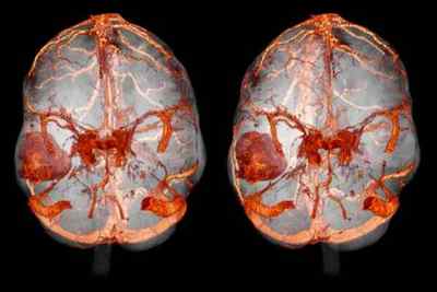 МРТ при епілепсії і діагностика ЕЕГ, критерії постановки діагнозу