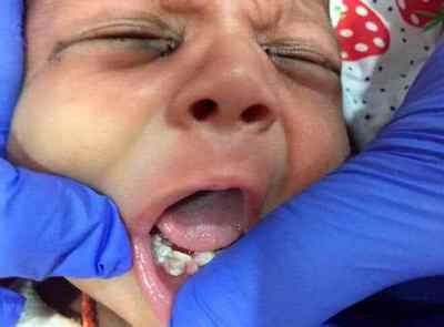 Місячній дитині з Індії видалили сім зубів