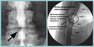 Мієлографія хребта: що це таке, МРТ відділу хребта і мієлографія з тривимірною реконструкцією | Ревматолог