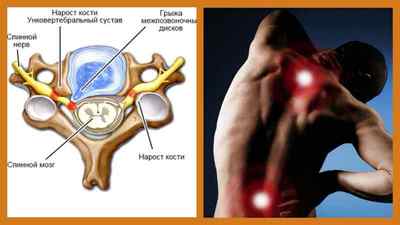 Міжостисті неоартроз хребта: що це таке і лікування, унковертебральний неоартроз шийного відділу, симптом Бострупа | Ревматолог