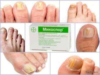 Набір Микоспор для лікування нігтів: інструкція із застосування, ціна, відгуки, аналоги