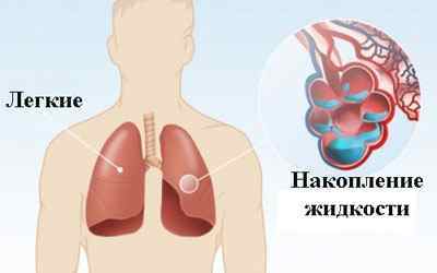 Набряк легенів: причини, симптоми, лікування і наслідки