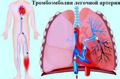 Набряк легенів: причини, симптоми, лікування і наслідки