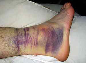 Набряк ноги після перелому - причини і методи лікування