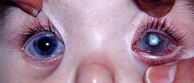 Набряк рогівки ока: симптоми, лікування після операції