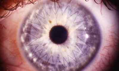 Набряк рогівки ока: симптоми, лікування після операції