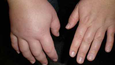 Набряк рук: причини і лікування опухлих кистей і пальців, що робити якщо опухла ліва або права рука і як зняти набряк | Ревматолог