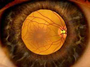 Набряк сітківки ока: лікування, причини, механізм утворення, як лікувати народними засобами