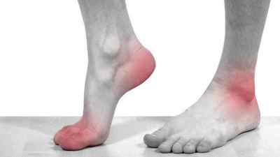 Набряк стопи ноги: причини чому опухають ноги в ступнях і лікування, що робити якщо сильно болить підошва | Ревматолог