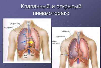Нагноїтельниє захворювання легень, їх особливості та лікування