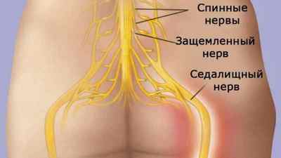 Народні засоби для лікування сідничного нерва (ішіасу): як лікувати невралгію | Ревматолог
