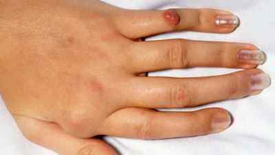 Нарости на суглобах пальців рук: причини і лікування шишки на суглобі народними засобами, як прибрати підшкірний наріст | Ревматолог