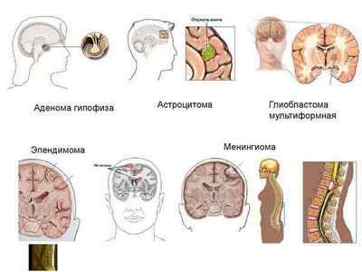 Наслідки після операції на менінгіому головного мозку