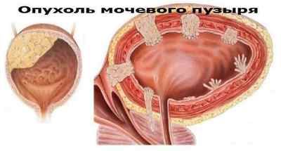 Наслідки та відгуки видалення сечового міхура у чоловіків
