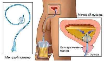 Наслідки та відгуки видалення сечового міхура у чоловіків