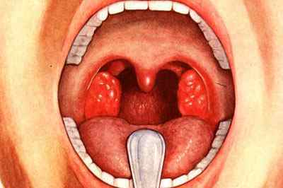 Настоянка календули для полоскання горла: правила приготування і застосування