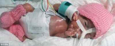 Найлегший недоношена дитина в світі вижив