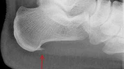 Нічний ортез при шпорі пяти: Страсбурзький носок на пяту своїми руками | Ревматолог