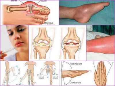 Недиференційований артрит: причини, симптоми, лікування