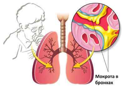 Невідкладна допомога при набряку легенів: алгоритм дій