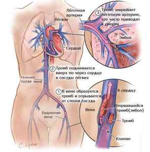 Невідкладна допомога при тромбоемболії легеневої артерії