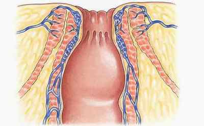 Невралгія прямої кишки: симптоми, лікування