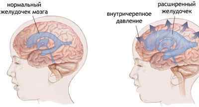 Невринома слухового нерва: симптоми, лікування, наслідки