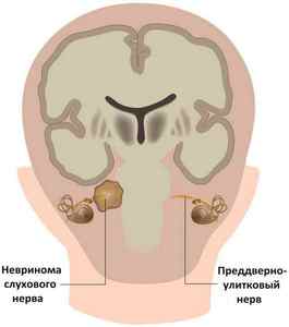 Невринома слухового нерва, симптоми і лікування пухлини, реабілітації