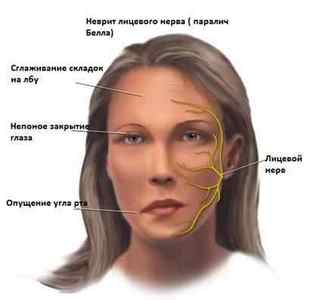 Неврит лицьового нерва: причини і лікування запалення