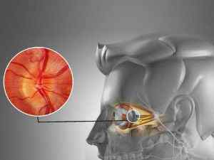 Неврит зорового нерва: симптоми і лікування запалення, як лікувати очні нерви