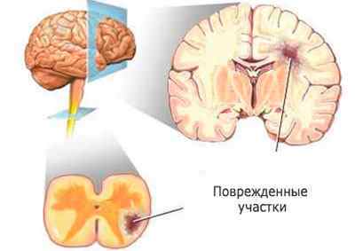 Невроз глотки: симптоми і лікування