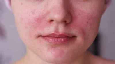 Нейродерміт на обличчі: симптоми і як швидко позбутися