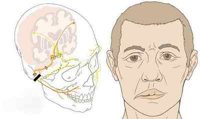 Нейропатія лицевого нерва, симптоми і лікування, МКБ-10